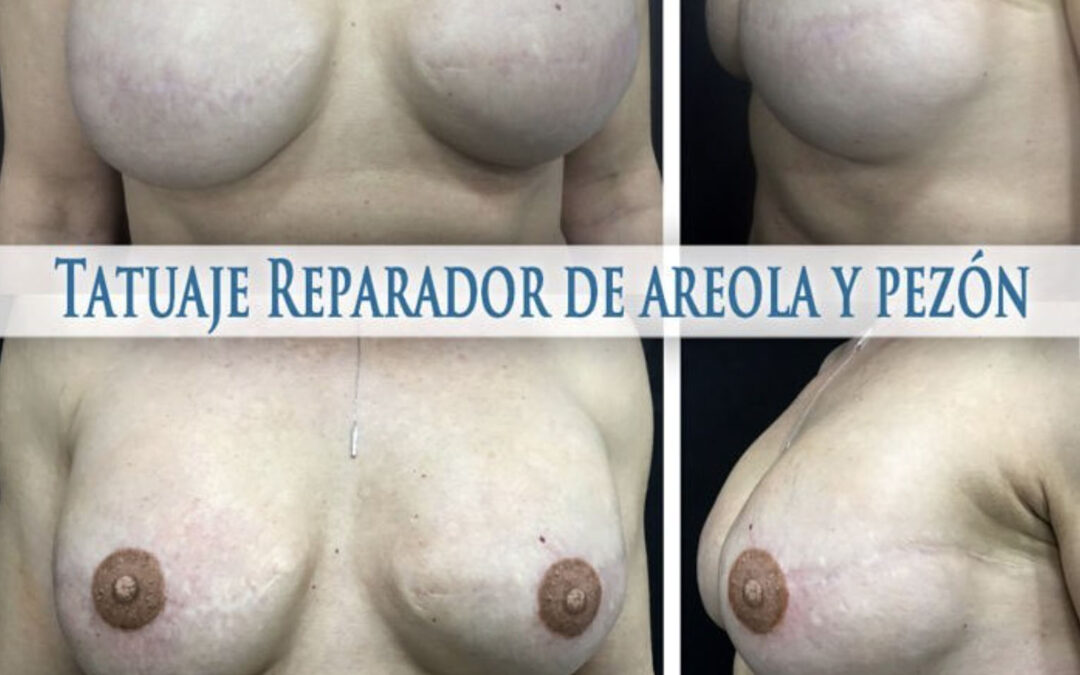 Reconstrucción de areola y pezón tras una mastectomía