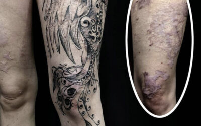 Tatuaje sobre quemaduras (I)