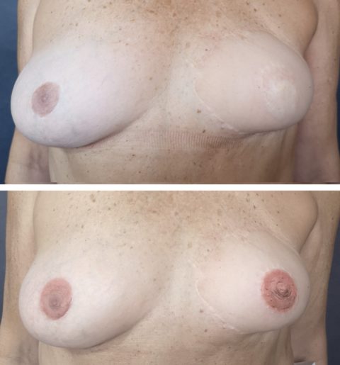 Tatuaje mastectomia sevilla