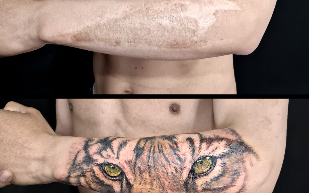 Tatuaje sobre injerto de piel