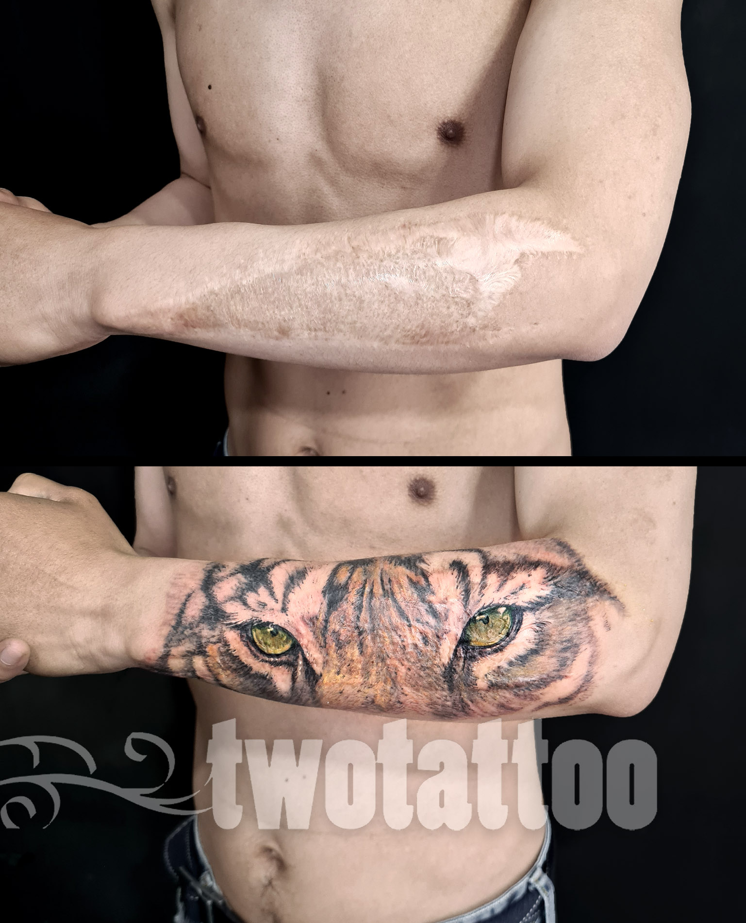 tatuaje sobre injerto de piel