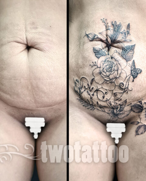 Tatuaje sobre abdominoplastia y cesarea