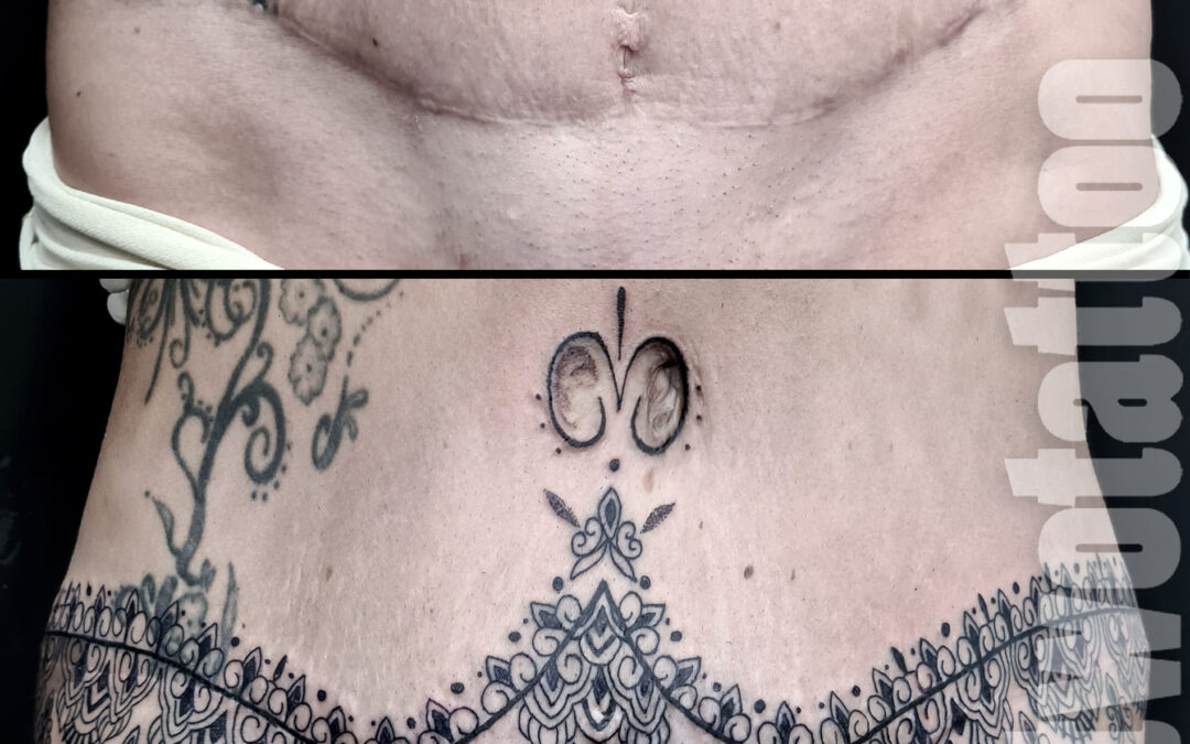 Tatuaje Reparador sobre abdominoplastia