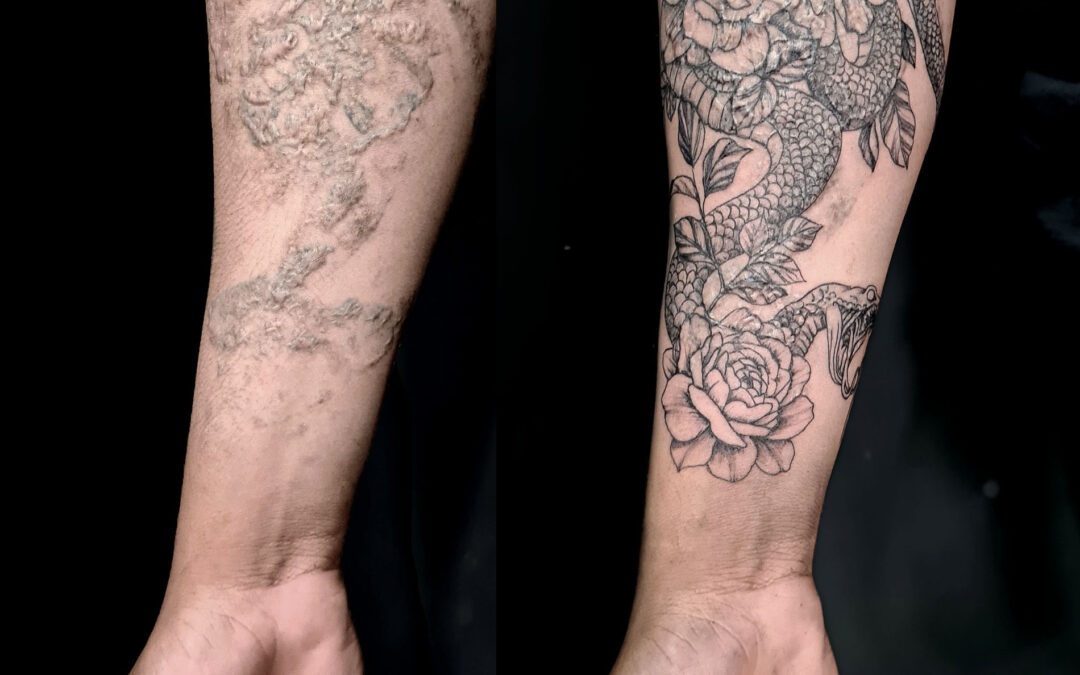 Tatuaje sobre queloides tras sesión de láser