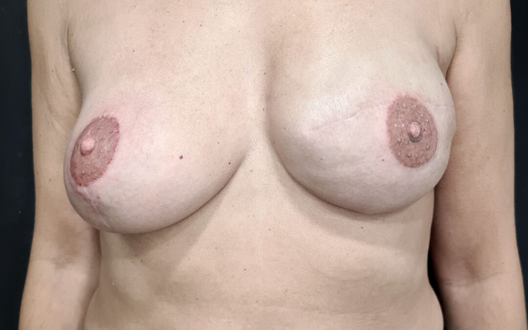 Tatuador en Sevilla de 3D tras cáncer de mama