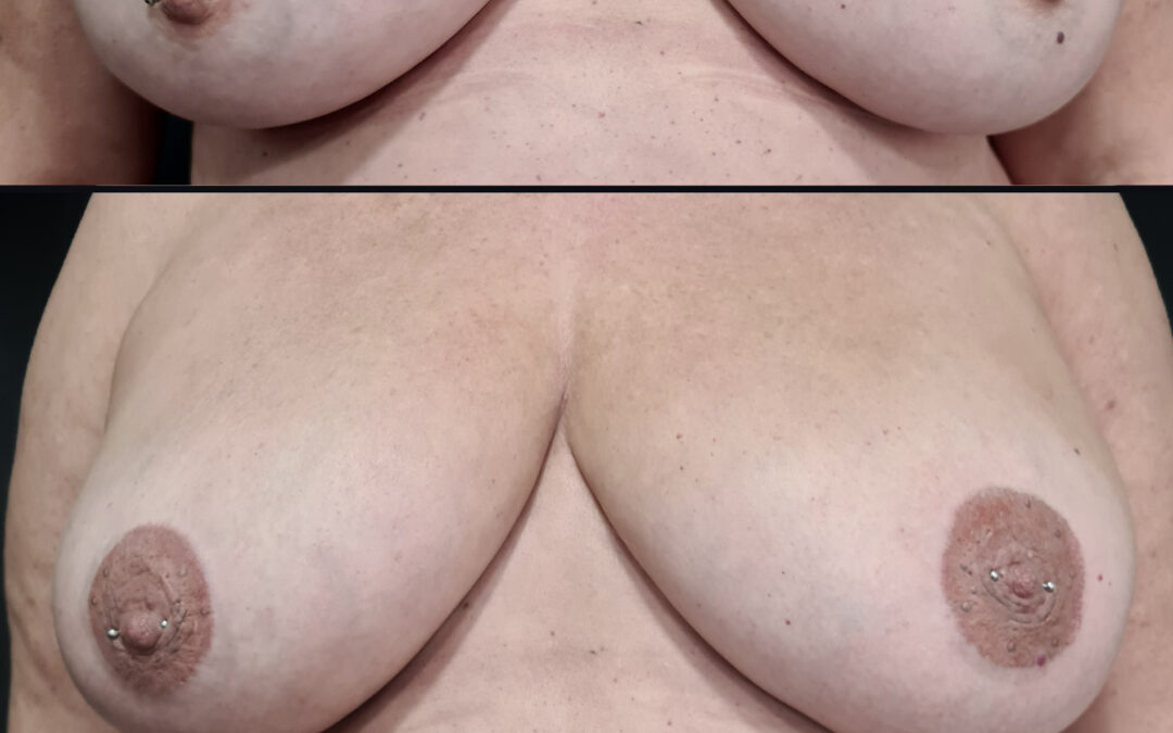 Tatuaje sobre micropigmentación en mamas