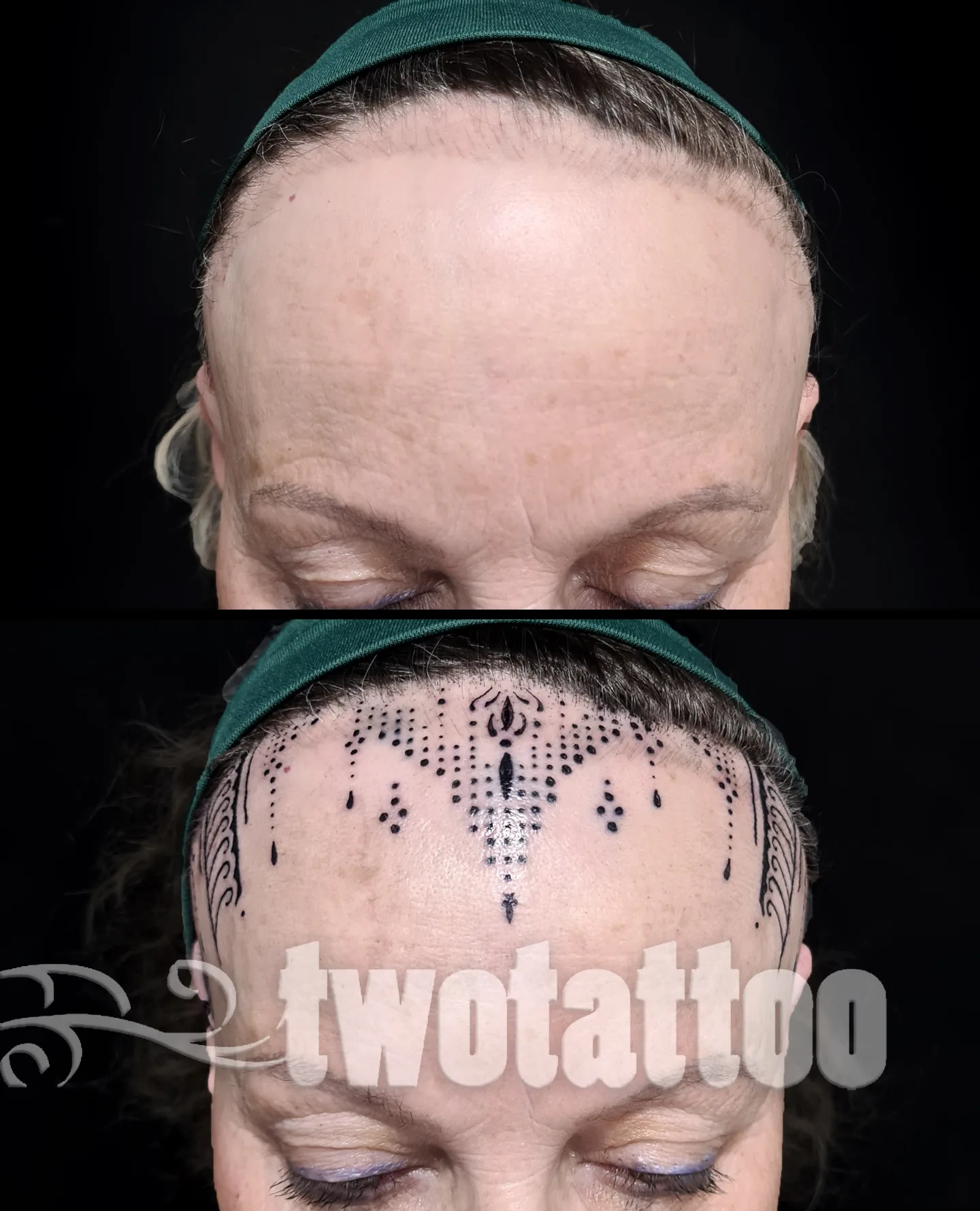 Alopecia y tatuaje