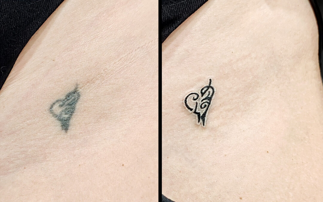 Arreglar tatuajes emborronados o con la tinta expandida