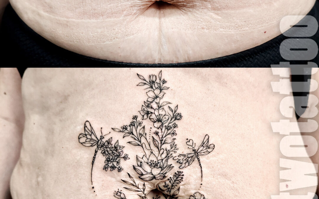 Tatuaje sobre estrías