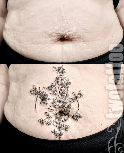 Tatuaje reparador sobre estrias
