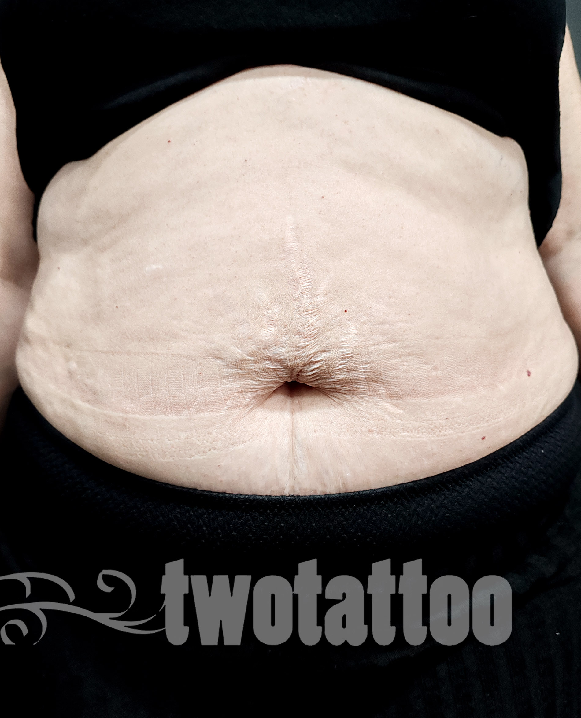 Tatuaje reparador sobre estrias. 