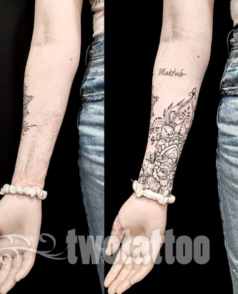 Tatuaje sobre quemaduras en la piel