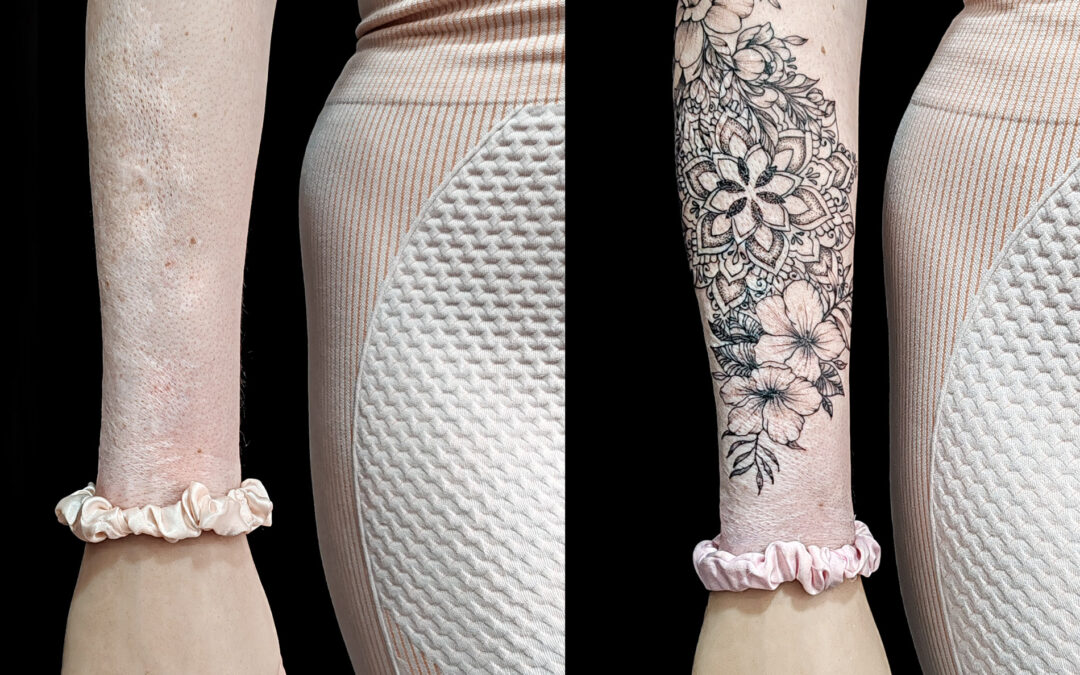 Tatuaje sobre quemaduras en la piel