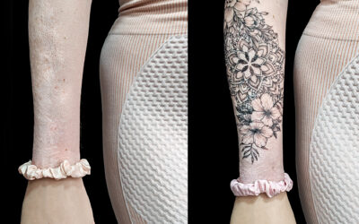 Tatuaje sobre quemaduras