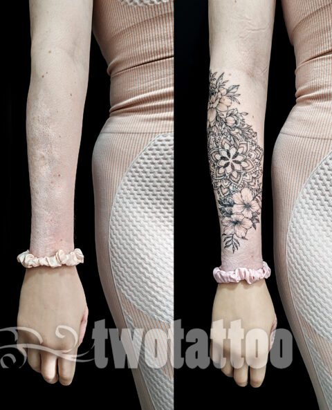 Tatuaje sobre quemaduras en la piel