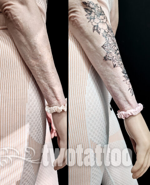 Tatuaje sobre quemaduras en la piel