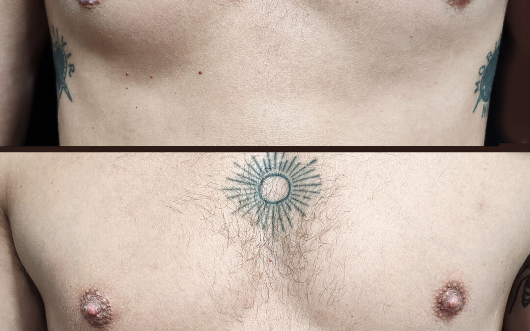 El vitíligo y el tatuaje