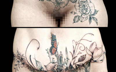 ¿Pueden operarme encima de un tatuaje?